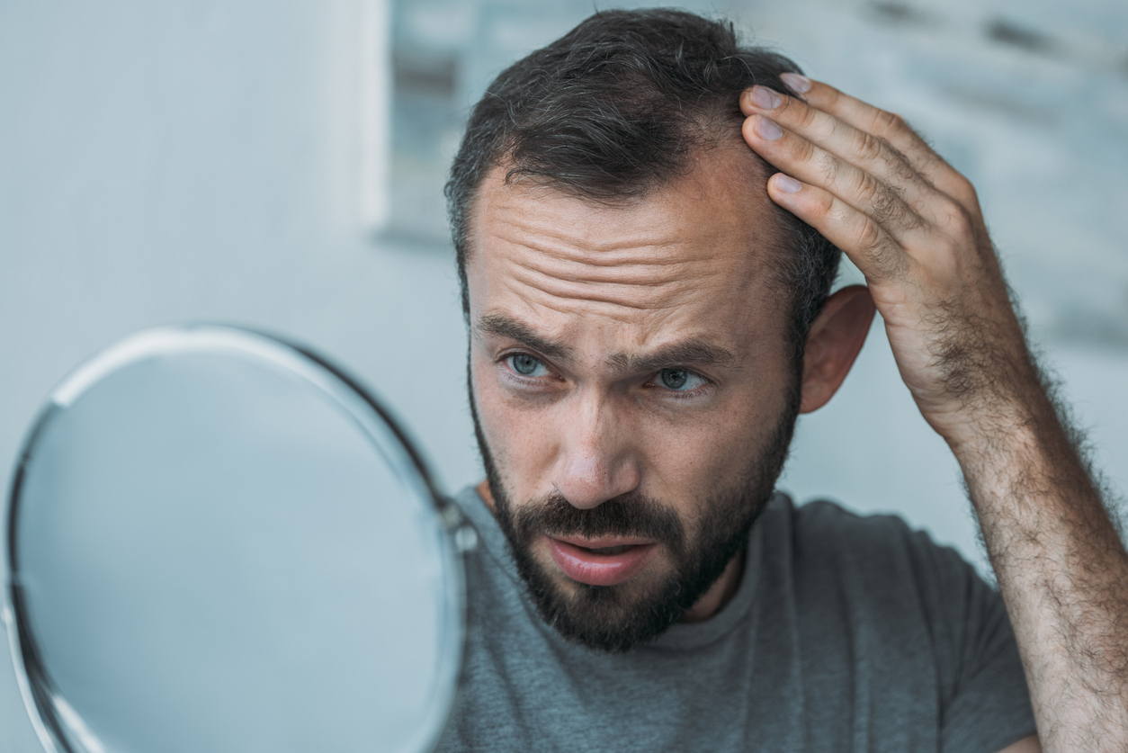 Qué hacer si te quedas calvo (o quieres prevenirlo) 